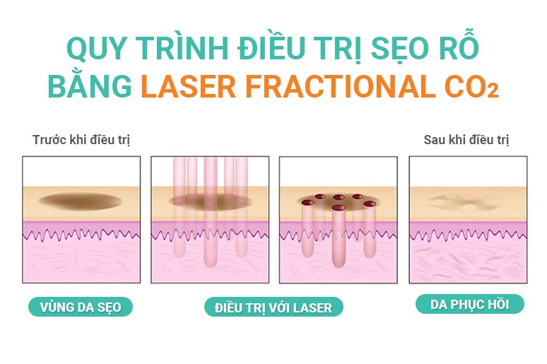 Phương pháp Laser Co2 Fractional trị sẹo lõm có thực sự hiệu quả?